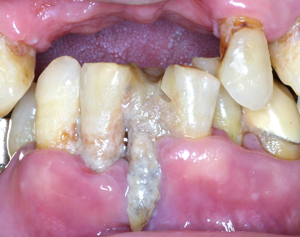 重度歯周病の口腔内写真