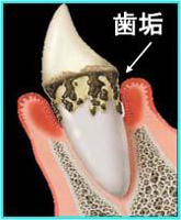 歯周病の歯の周囲にたまった歯垢