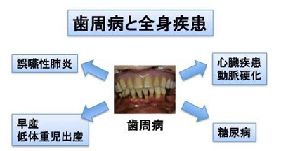 歯周病と全身疾患の関係を示す模式図