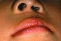 口唇裂の患者さんの写真。鼻から唇にかけて傷があります