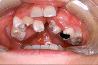 唇顎口蓋裂の口の中。歯並びが悪くなります