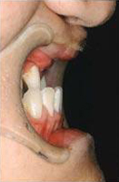 唇顎口蓋裂の歯並びを横から見たところ