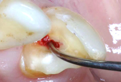 神経に達するむし歯