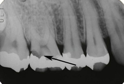 神経に達するむし歯のエックス線画像