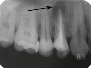 歯根の先端に膿がある状態のエックス線画像