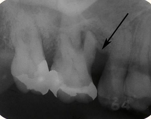 重度歯周病のエックス線画像