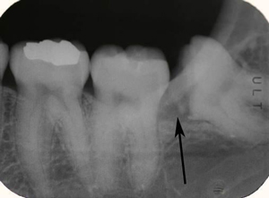 親知らずのむし歯のエックス線画像