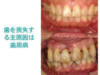 正常なお口の中（上）と重度な歯周病のお口（下）