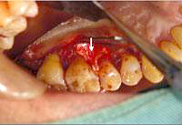歯周組織再生誘導法を行っているところ
