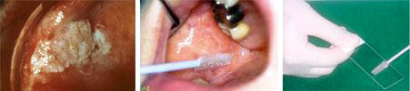 口腔粘膜の検査