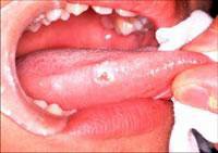 舌が白くて痛いのは 病院の特色 日本大学松戸歯学部付属病院