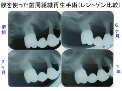 歯周組織再生手術